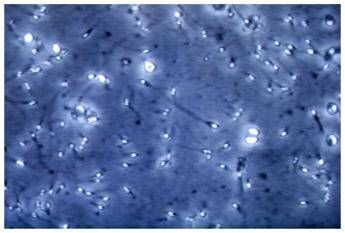 microplastiche nella prostata e nel liquido seminale la scoperta italiana cosa comporta 2